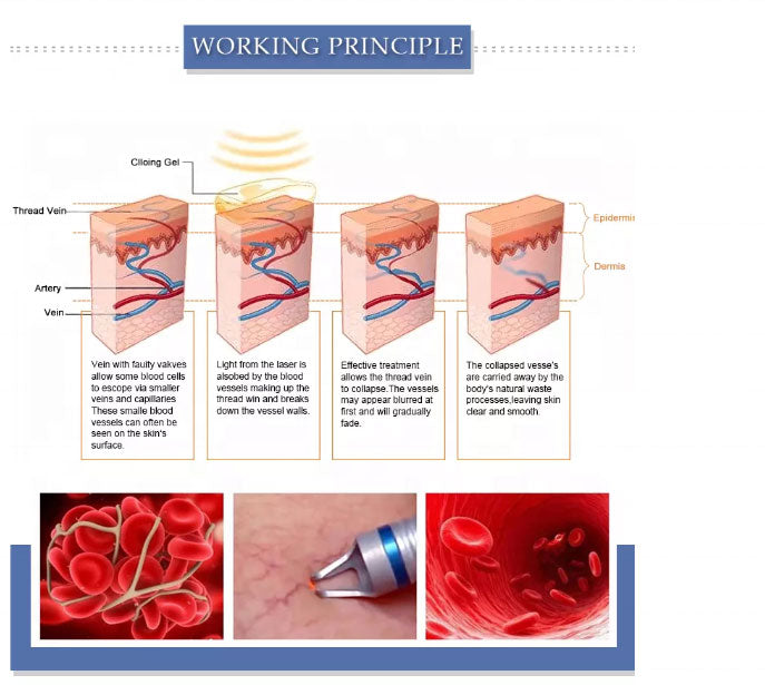 Portable 2 in 1 980nm Diode Laser Spider Vein Removal Equipment 980nm Vascular Removal Machine with Cold Hammer
