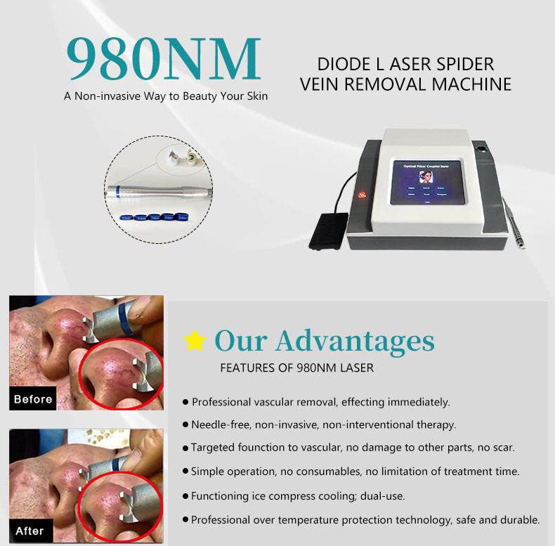 Profession 980nm Diode Laser Blood Vessels Removal Spider Vein Treatment Machine
