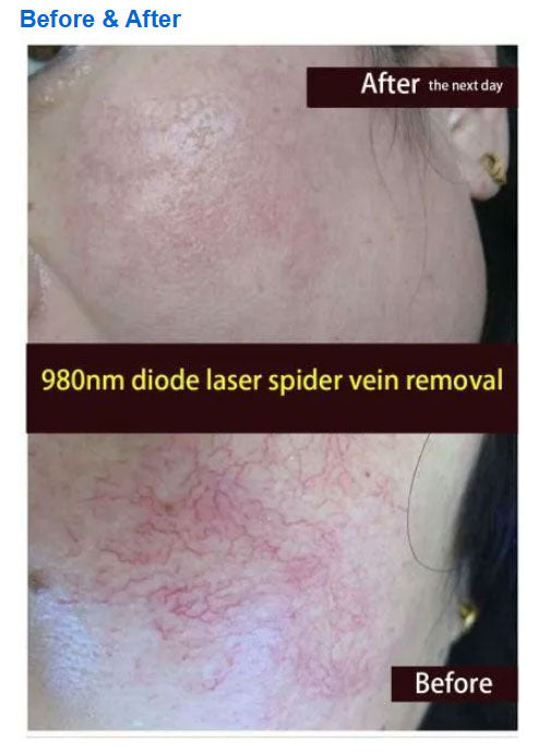 Profession 980nm Diode Laser Blood Vessels Removal Spider Vein Treatment Machine