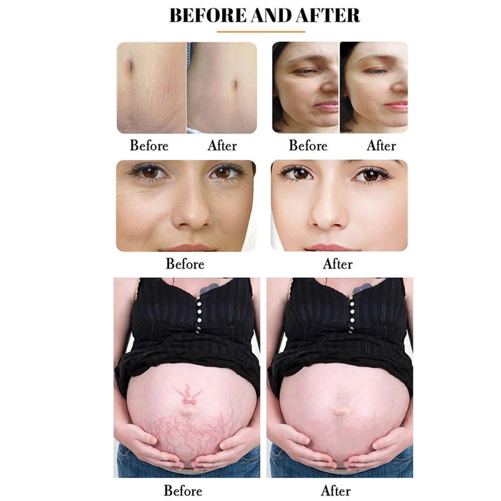 Portable 10600nm Fractional CO2 Laser Machine for Acne Scar Removal Skin Rejuvenation