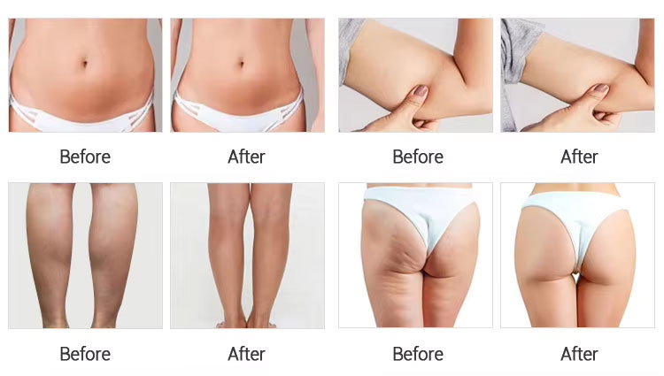 G5 High Frequency Vibration Massage Slimming Machine