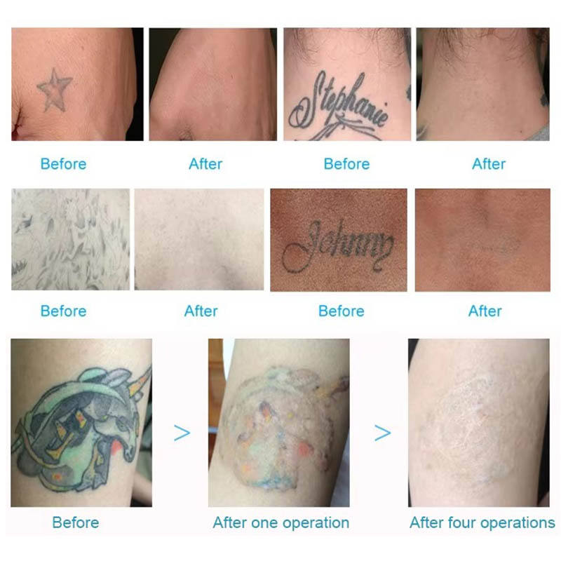 Carbon Peeling Black Doll Treatment 6 Optional Heads Pico Second Lasersings Tattoo Removal Machine