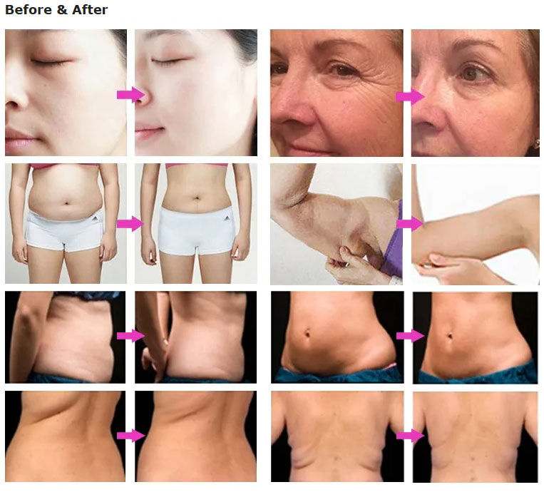 3 in 1 Cavitation RF Slimming Skin Tightening Machine