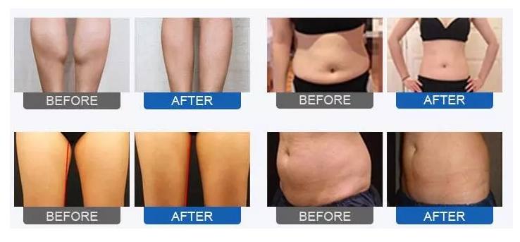 Beauty Salon Equipment Presoterapia Air Pressure Body Slimming Suit Lymphatic Drainage Pressotherapy Machine